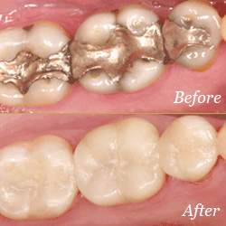 fillings image