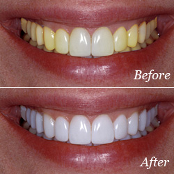 teeth whitening image