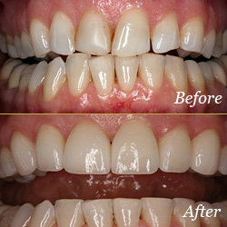 veneers image